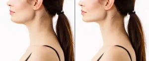 Nefertiti Lift Treatment