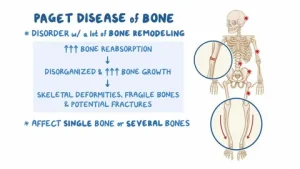 Paget Disease