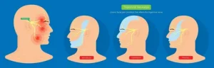 Neuralgia Treatment