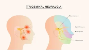 Trigeminal Neuralgia Treatment