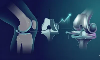 Hip and Knee Implant