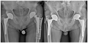 Hip and Knee Implant