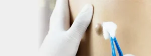 lipoma treatment