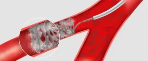 Peripheral Embolization Coils