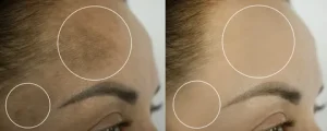 Skin Pigmentation