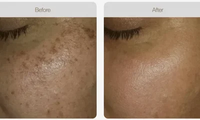 Skin Pigmentation