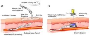 Catheter-related Bloodstream Infections