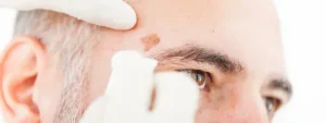 Seborrheic Keratosis