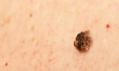 Seborrheic Keratosis