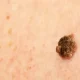 Seborrheic Keratosis