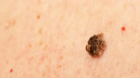 Seborrheic Keratosis