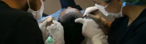 hair transplant