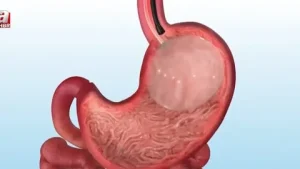 Gastric Balloon