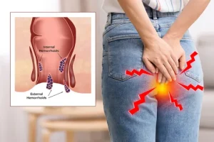 Anal Burning Cause