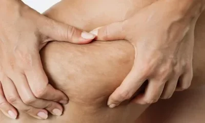 Cellulite Treatment