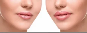 Lip Augmentation