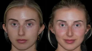 Rhinoplasty