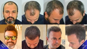 1 Dirham Hair Transplant