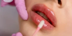 Lip Fillers Injection