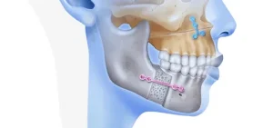 Jaw Surgery