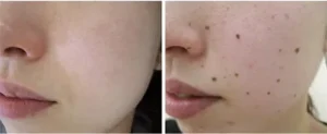 Birthmark Removal