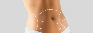 Tummy Tuck