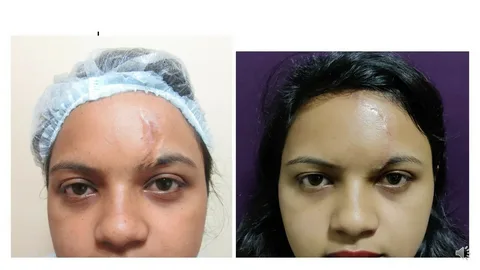 Scar Treatment
