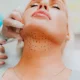 Kybella Treatment