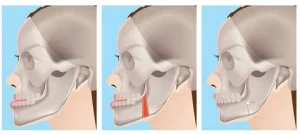 Jaw Alignment Treatment