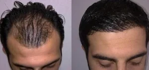 Hair Transplant