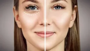 Eye Bag Removal