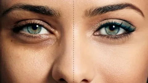 Eye Bag Removal