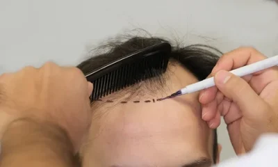 Hair Transplant
