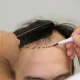 Hair Transplant
