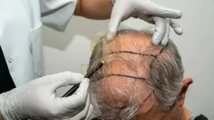 Hair Transplant