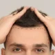 Hair Transplant