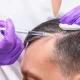 PRP Hair Treatment