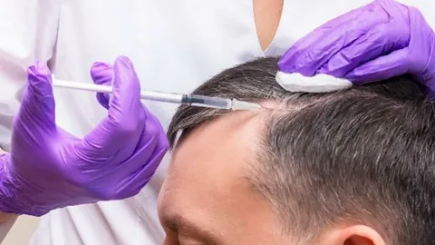 PRP Hair Treatment