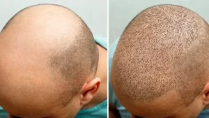 Hair Transplant