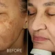 Skin Toning