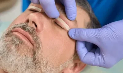 Blepharoplasty