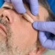 Blepharoplasty